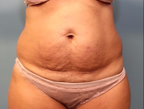 before tummy tuck front view female patient case 35