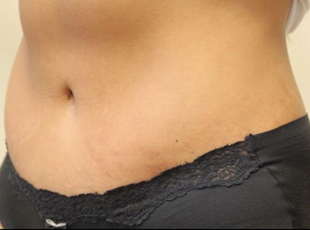 after tummy tuck left angle view female patient case 33