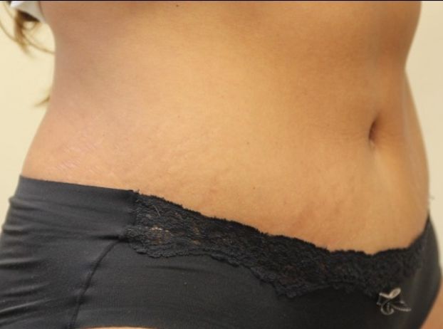 after tummy tuck right angle view female patient case 33