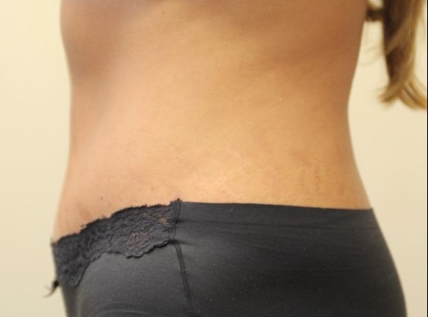 after tummy tuck left view female patient case 33