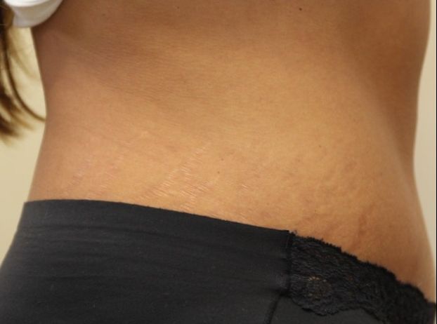 after tummy tuck right view female patient case 33