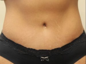 after tummy tuck front view female patient case 33