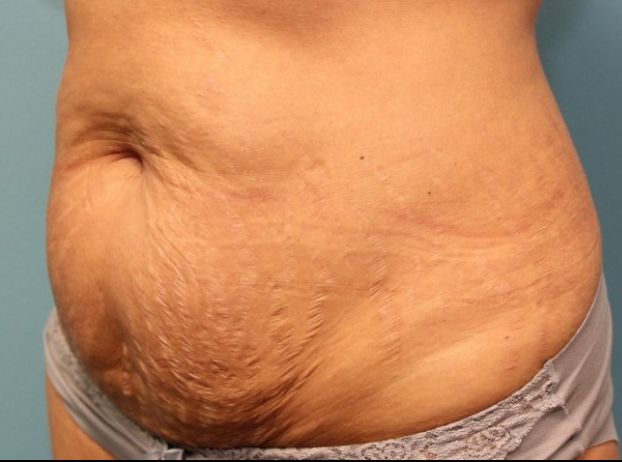before tummy tuck left angle view female patient case 33