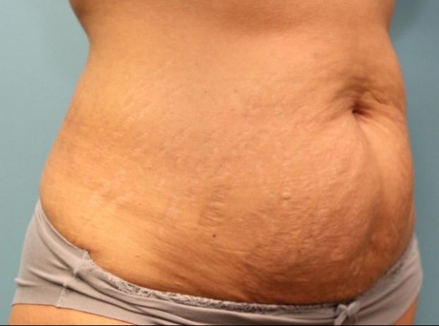 before tummy tuck right angle view female patient case 33