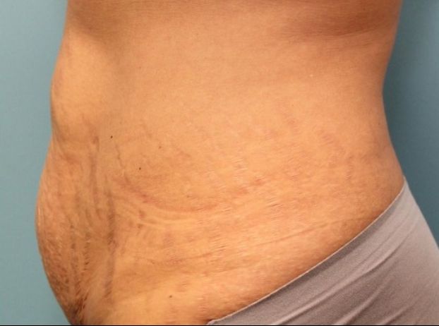 before tummy tuck left view female patient case 33