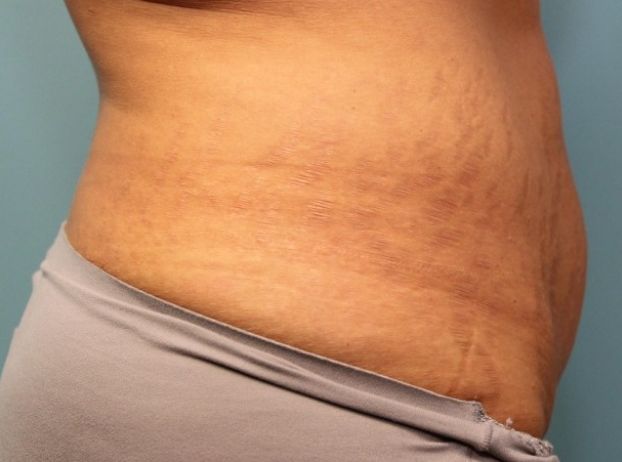before tummy tuck right view female patient case 33