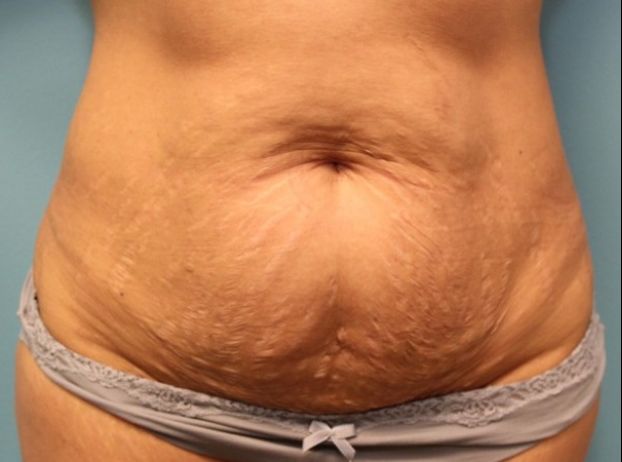 before tummy tuck front view female patient case 33
