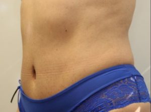 after tummy tuck left angle view female patient case 32