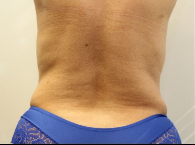 after tummy tuck back view female patient case 32