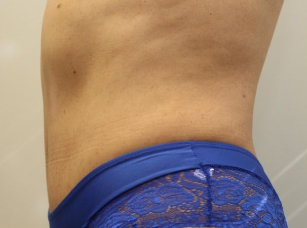 after tummy tuck left view female patient case 32