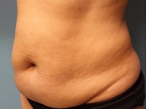 before tummy tuck left angle view female patient case 32