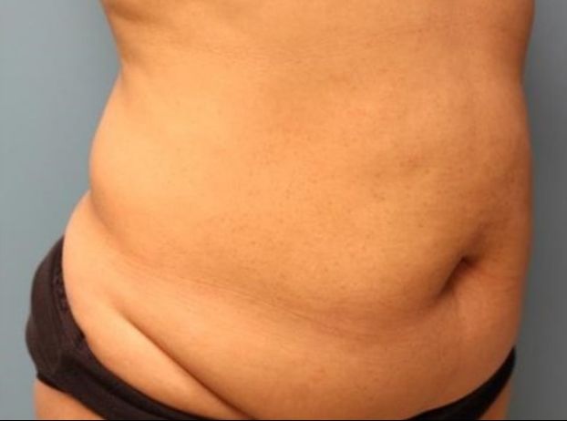 before tummy tuck right angle view female patient case 32
