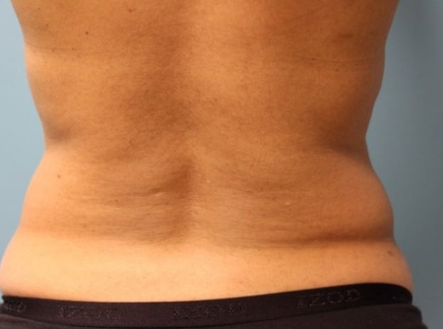 before tummy tuck back view female patient case 32