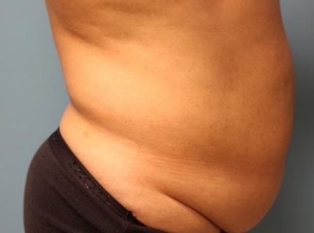 before tummy tuck right view female patient case 32