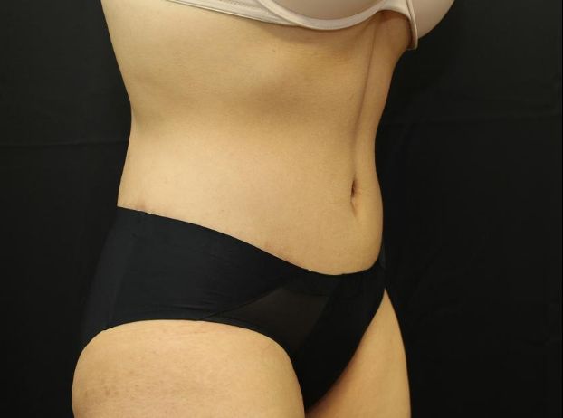 after tummy tuck right angle view female patient case 31