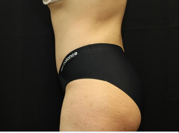 after tummy tuck left angle view female patient case 31