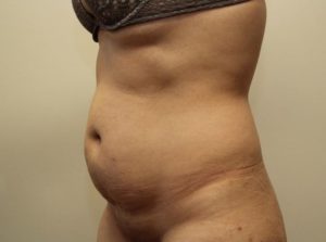 before tummy tuck left angle view female patient case 31