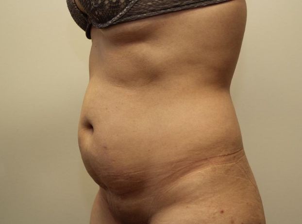 before tummy tuck left angle view female patient case 31