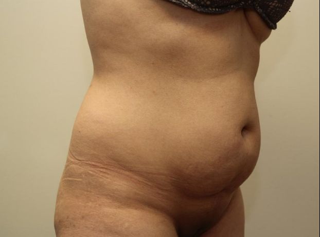 before tummy tuck right angle view female patient case 31