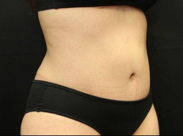 after tummy tuck right angle view female patient case 29