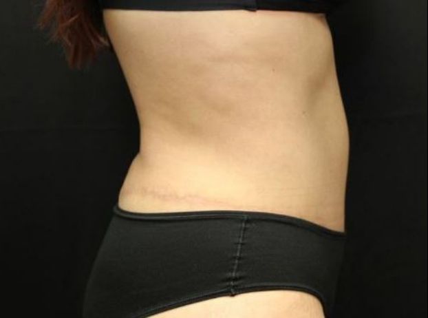 after tummy tuck right view female patient case 29