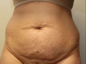 before tummy tuck front view female patient case 29