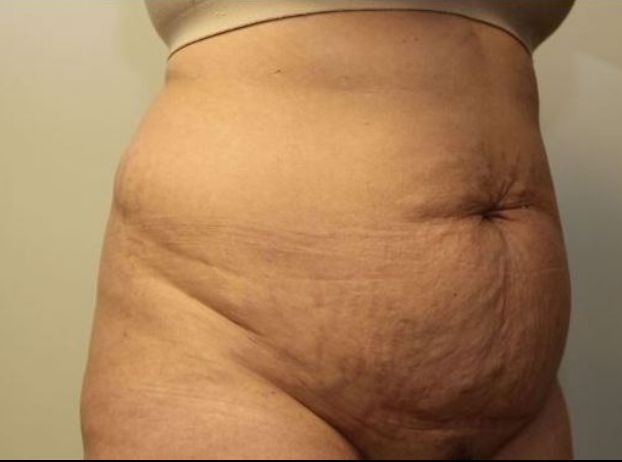 before tummy tuck right angle view female patient case 29
