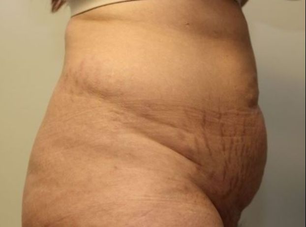 before tummy tuck right view female patient case 29