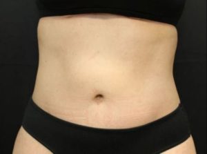 after tummy tuck front view female patient case 29