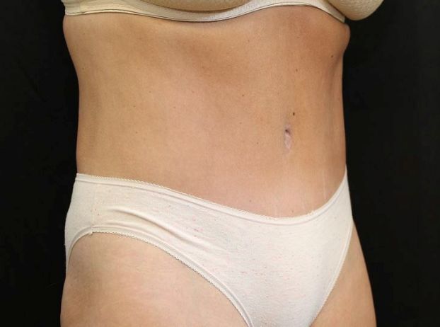 after tummy tuck right angle view female patient case 27
