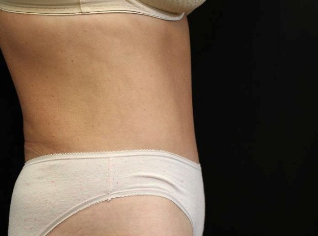 after tummy tuck right view female patient case 27