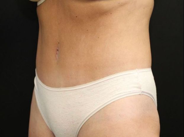 after tummy tuck left angle view female patient case 27
