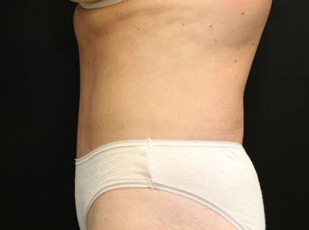after tummy tuck left side view female patient case 27