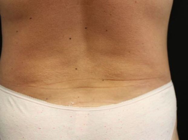 after tummy tuck back view female patient case 27