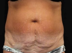 before tummy tuck front view female patient case 27