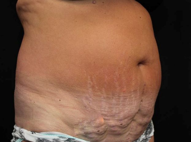 before tummy tuck right angle view female patient case 27