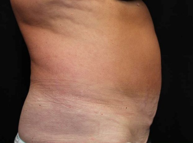 before tummy tuck right view female patient case 27