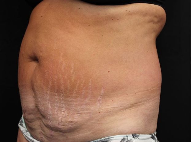 before tummy tuck left angle view female patient case 27