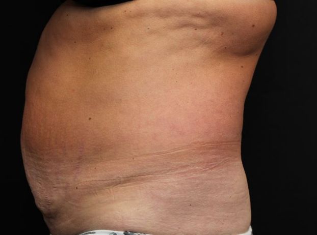before tummy tuck left side view female patient case 27