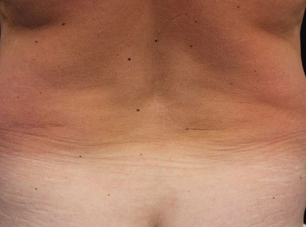 before tummy tuck back view female patient case 27