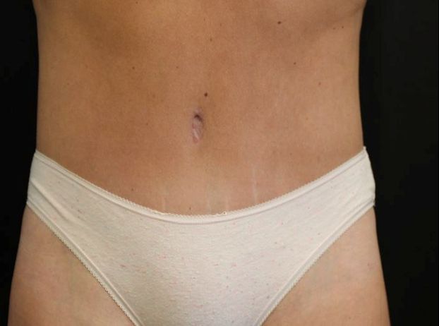 after tummy tuck front view female patient case 27