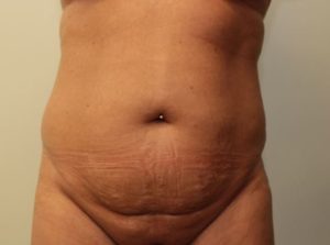 before tummy tuck front view female patient case 25