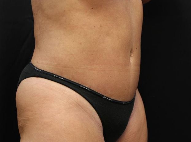 after tummy tuck right angle view female patient case 25