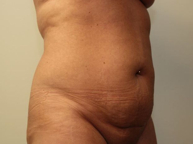 before tummy tuck right angle view female patient case 25