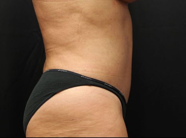 after tummy tuck right view female patient case 25