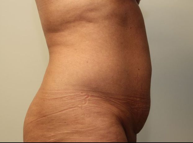 before tummy tuck right view female patient case 25
