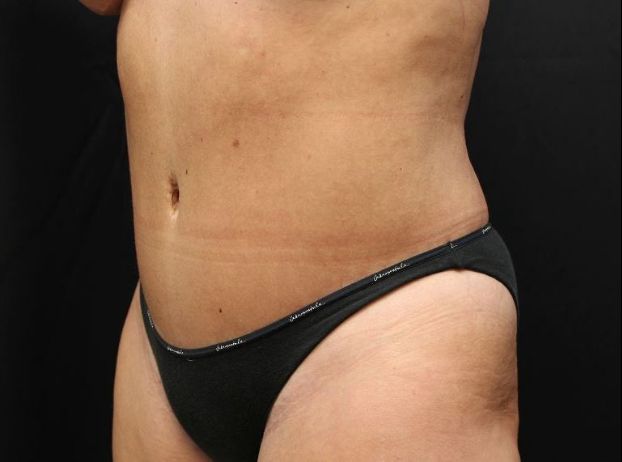 after tummy tuck left angle view female patient case 25