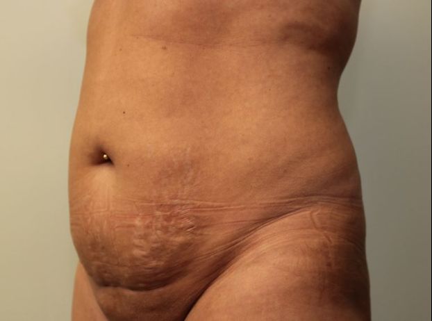 before tummy tuck left angle view female patient case 25