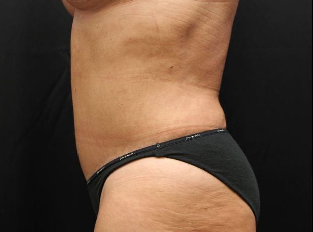 after tummy tuck left view female patient case 25