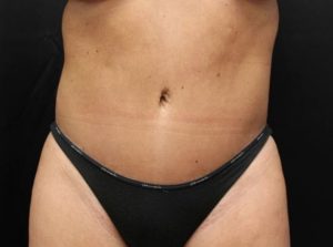 after tummy tuck front view female patient case 25